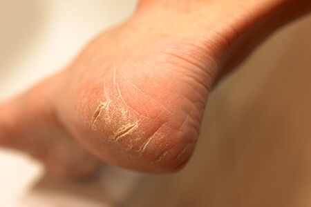 Cracked heels, white female feet. Close-up. need for pedicure, very dry skin, vitamin deficiency.