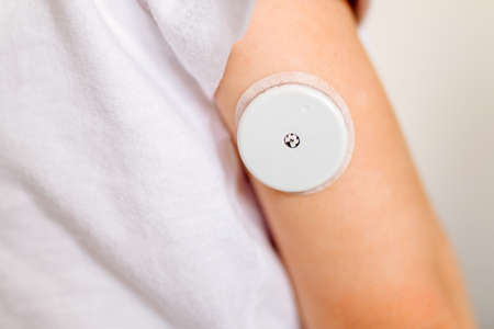 CGM -system of continuous monitoring of glucose on childs arm.