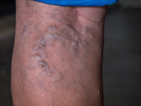 Closeup of the varicose veins on a leg of old womanの写真素材