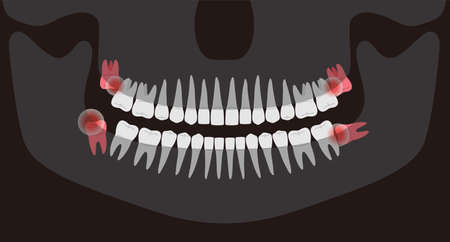 Human X-ray picture of teeth, vector illustration;, Inflamed teeth of human, It hurts in the mouthのイラスト素材