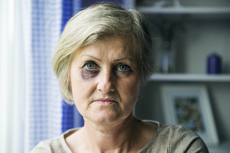 Senior woman with black eye is victim of domestic violenceの写真素材
