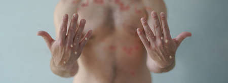 Male hands affected by blistering rash because of monkeypox or other viral infection on white backgroundの写真素材