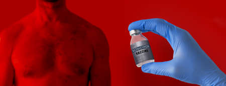 Doctors hand holding monkeypox vaccine with male chest affected by blistering rash because of monkeypox on red background.の写真素材