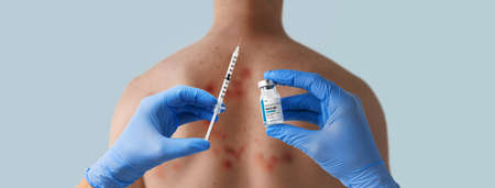 Doctors hand holding monkeypox vaccine with male back affected by blistering rash because of...
