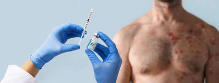 Doctors hand holding monkeypox vaccine with male chest affected by blistering rash because of...