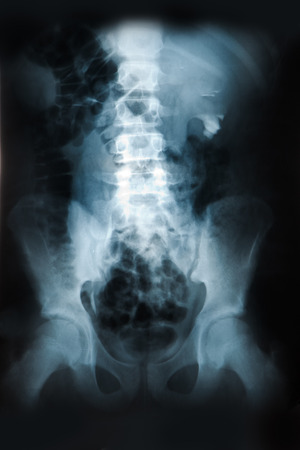 X-ray of the pelvis and spinal column.の写真素材