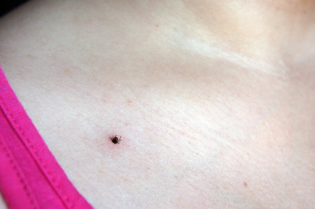 Tick sucking blood from human skinの写真素材