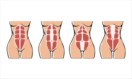 Different types of Diastasis. Diastasis in a woman after pregnancy. 
Woman anatomy. Muscle corset of a woman after childbirth. Vector illustrationのイラスト素材