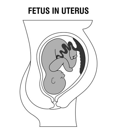 Placental previa. Fetus in Uterus During Pregnancy. Pregnancy women anatomy. Fetus with umbilical cord and placenta.
Usual anatomical Placenta Location. Detailed medical vector illのイラスト素材