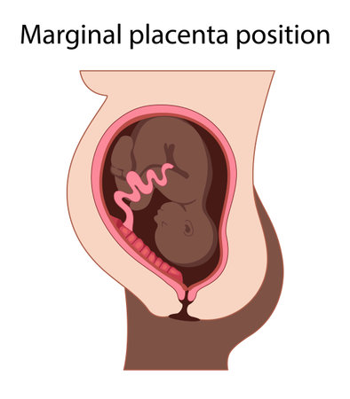 Different Placental Locations.  Fetus in Uterus During Pregnancy. Normal, top, low previa and front position.  
Pathology. Detailed medical vector illustration.のイラスト素材