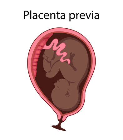 Different Placental Locations.  Fetus in Uterus During Pregnancy. Normal, top, low previa and front position.  
Pathology. Detailed medical vector illustration.のイラスト素材