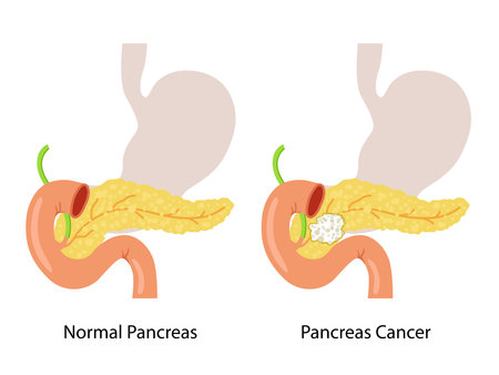 Pancreas or Pancreatic Cancer with organs and Tumors. Cancerous cells for education material, brochure, website, medical portal, atlas, textbook, presentation. Oncology, disease, mのイラスト素材