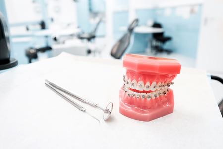 dental model with braces - Teeth orthodontic dental model with dental braces in dentist clinic