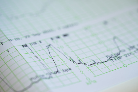 Printing of cardiogram report coming out from Electrocardiograph in labour wardの写真素材
