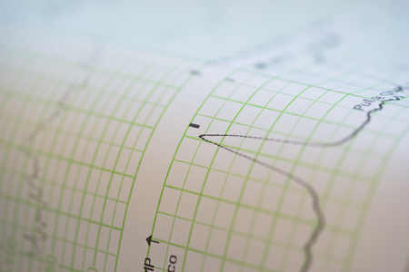 Printing of cardiogram report coming out from Electrocardiograph in labour wardの写真素材