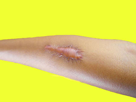 Surgery on the arm Separate on a yellow background.の写真素材