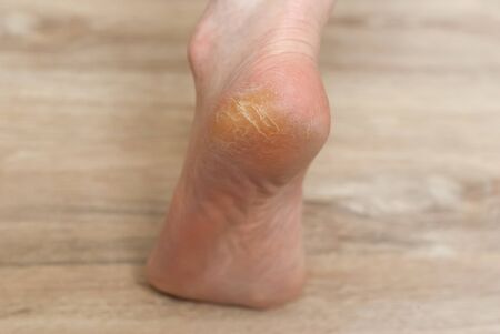 clavus and cracks on the heel of female foot close-upの写真素材