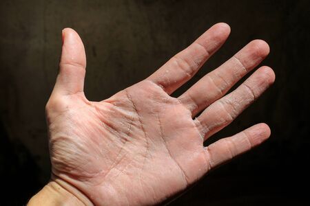 right hand skin peeling due to an allergic reaction on dark backgroundの写真素材