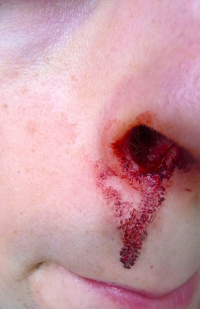 Dried up blood from a nose bleed.