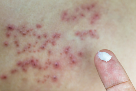 Raised red bumps and blisters on skin with white cream on fingerの写真素材