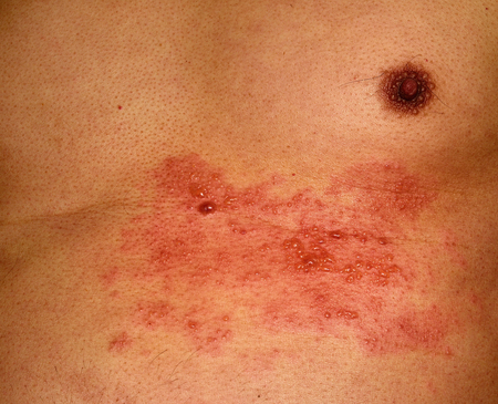 Herpes zoster (shingles) in the chest areaの写真素材