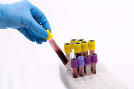 blood test tubes white background, virus blood test,