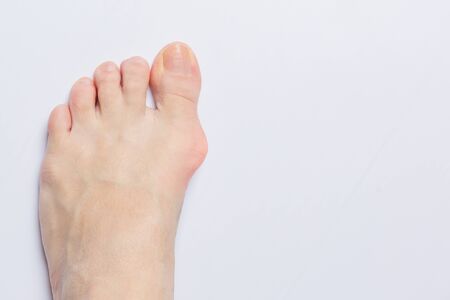 Bunion before surgical removal. Bunion at side of a foot  isolated on gray white background. Bone and skin on the sides of joint of the big toe make abnormal foot shape, Problem form wearing high heelの写真素材