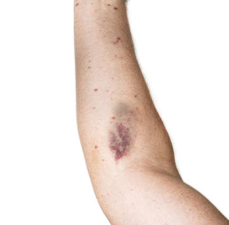Subcutaneous hematoma due to poor blood extraction. Concept malpractice, health and medicine,...