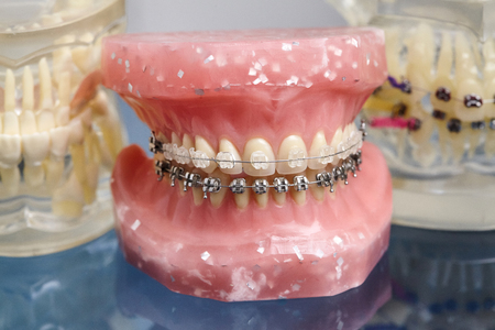 Human jaw or teeth model with metal wired dental braces, orthodontic presentation tool, closeupの写真素材