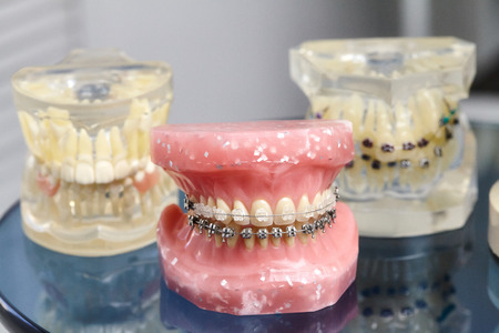 Human jaw or teeth model with metal wired dental braces, orthodontic presentation tool, closeup