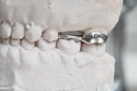 Gray dental prosthesis teeth mold, clay human gums model in jaws prothetic laboratoryの写真素材