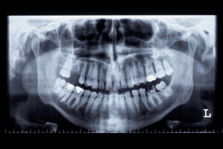 Panorama x-ray image of a human jawの写真素材