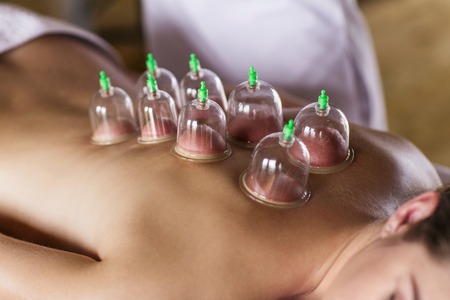 Woman laying on chest with cupping treatment on backの写真素材