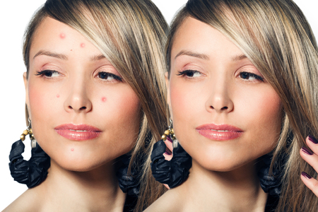 Young beautiful woman with problem skin on her faceの写真素材