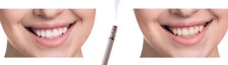 Smile before and after smoking. Concept of healthy smileの写真素材