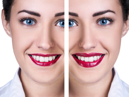 Lips before and after filler injections isolated on white. Lips augmentation concept.の写真素材