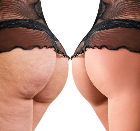 Female buttocks before and after cellulite skin isolated on white