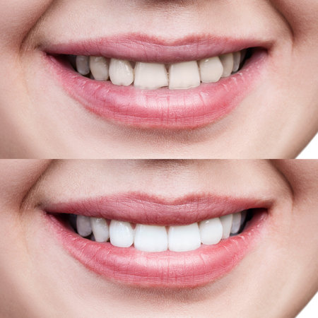 Teeth of young woman before and after whitening.の写真素材