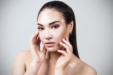 Portrait of beautiful woman with vitiligo.の写真素材