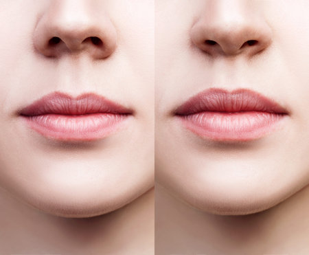 Front view on female nose before and after surgery.の写真素材