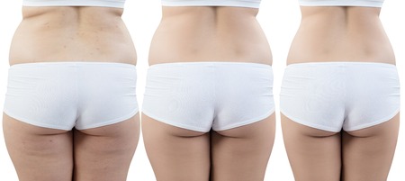 Female buttocks before and after sport and treatment.の写真素材