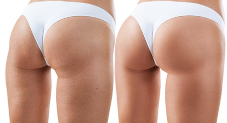 Female buttocks before and after treatment.の写真素材