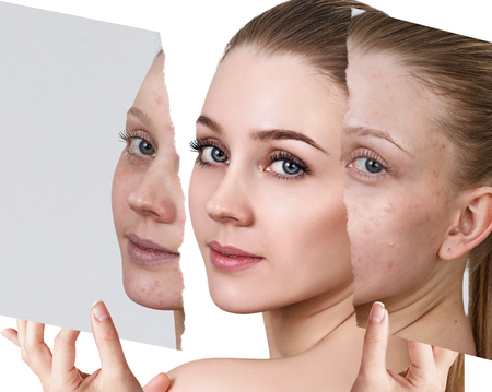 Compare of old photo with acne and new healthy skin.の写真素材