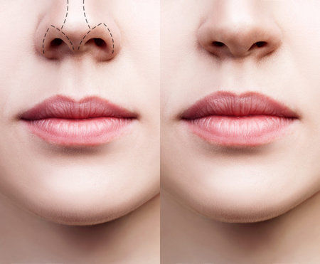 Lips of young woman before and after augmentationの写真素材