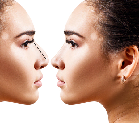Female nose before and after cosmetic surgery.の写真素材