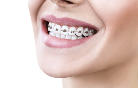 Young woman smiling with braces on teeth.