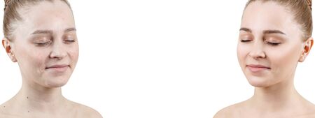 Woman with acne before and after treatment and make-up. Copy space.の写真素材