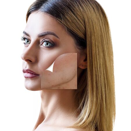 Layer with bad skin unstick from good healthy skin.の写真素材