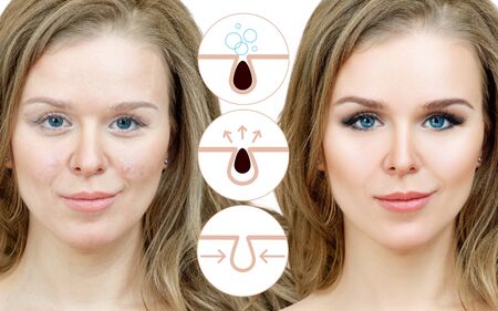 Graphically shows how to pollute and clean the pores on face.の写真素材