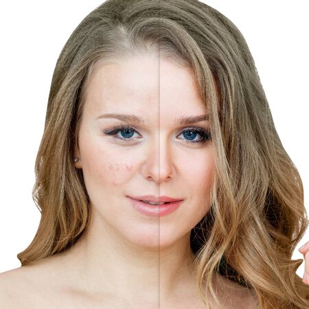 Woman with acne before and after treatment and makeup.の写真素材